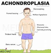 Image result for Achondroplasia X-ray