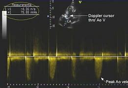 Image result for Aortic Stenosis Doppler