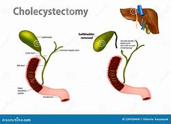 Image result for Open Gallbladder Removal