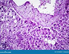 Image result for Swelling of Liver