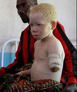 Image result for South African Albino