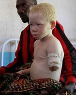 Image result for White Albino Africans