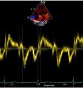 Image result for Myocardium of Interventricular Septum