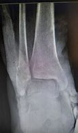 Image result for Trimalleolar Ankle Fracture with Syndesmotic Disruption