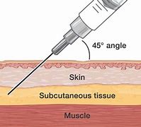 Image result for Subcutaneous Injection