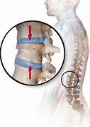 Image result for Imagees Compression Fracture of Lumbar Vertebrae