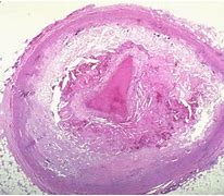 Image result for Thrombosis Histology