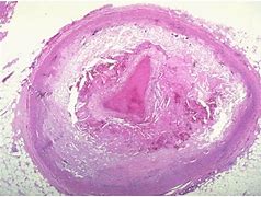 Image result for Organizing Thrombus Histology