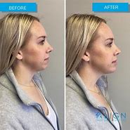 Image result for 1 Unit Chin Filler