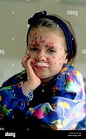 Image result for Pox Baby Girl