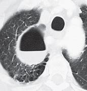 Image result for Distal Acinar Emphysema