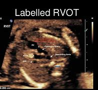 Image result for Abnormal Fetal Heart Ultrasound