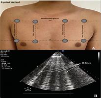 Image result for B Lines Chest Ultrasound