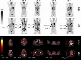 Image result for Pet Scan Lymphoma Example