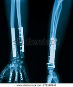 Image result for X-ray of Leg with Metal Plates