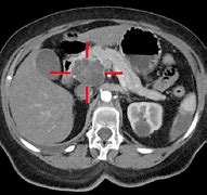 Image result for Pancreatic Adenocarcinoma