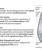 Image result for Extra-Axial Posterior Fossa Mass