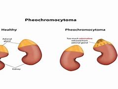 Image result for Pheochromocytoma Renin