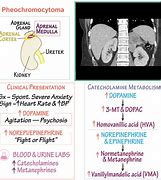 Image result for Light Bulb Sign Pheochromocytoma