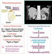 Image result for 5 Ps of Pheochromocytoma