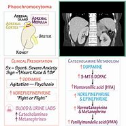 Image result for Pheochromocytoma Renin