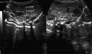 Image result for Hemangioma Ultrasound