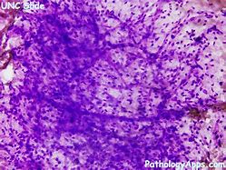 Image result for Myxoid Liposarcoma