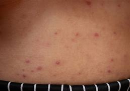 Image result for Viral Pustules