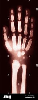 Image result for Child's Hand X-ray