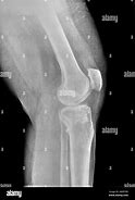 Image result for Normal Lateral Knee Radiograph