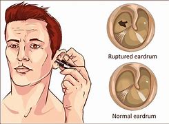 Image result for Tympanic Perforation