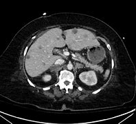 Image result for Spleen Metastasis