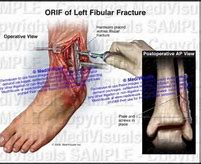 Image result for ORIF Ankle Fracture