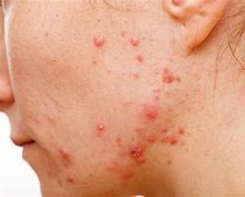 Image result for Large Acne Pustules