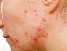 Image result for Pustules Back