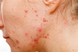 Image result for What Are Pustules On the Skin