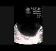 Image result for Distended Bladder