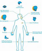 Image result for Cerebral Ataxia