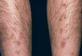 Image result for Diabetes Skin Darkening