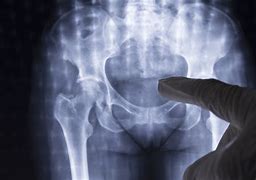 Image result for Radiotherapy Rectal Cancer