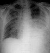 Image result for Empyema Thoracis X-ray