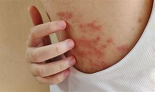 Image result for Hives with Pustules