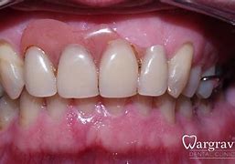 Image result for Upper Partial Dentures Pictures