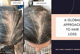 Image result for Low Dose Minoxidil for Hair Loss