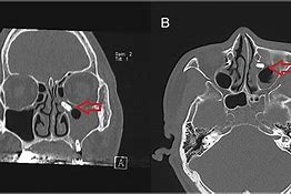 Image result for Infundibulum Nose