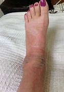 Image result for Fractured Ankle Symptoms