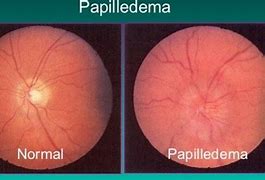 Image result for Papilledema