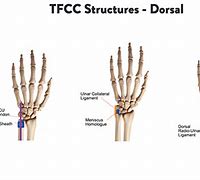 Image result for Outer Wrist Pain