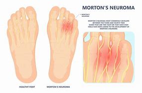 Image result for Dorsal Foot Nerve Pain