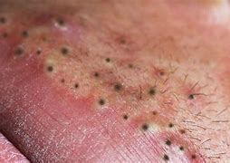 Image result for Pimple Popping